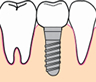 インプラント（保険外）